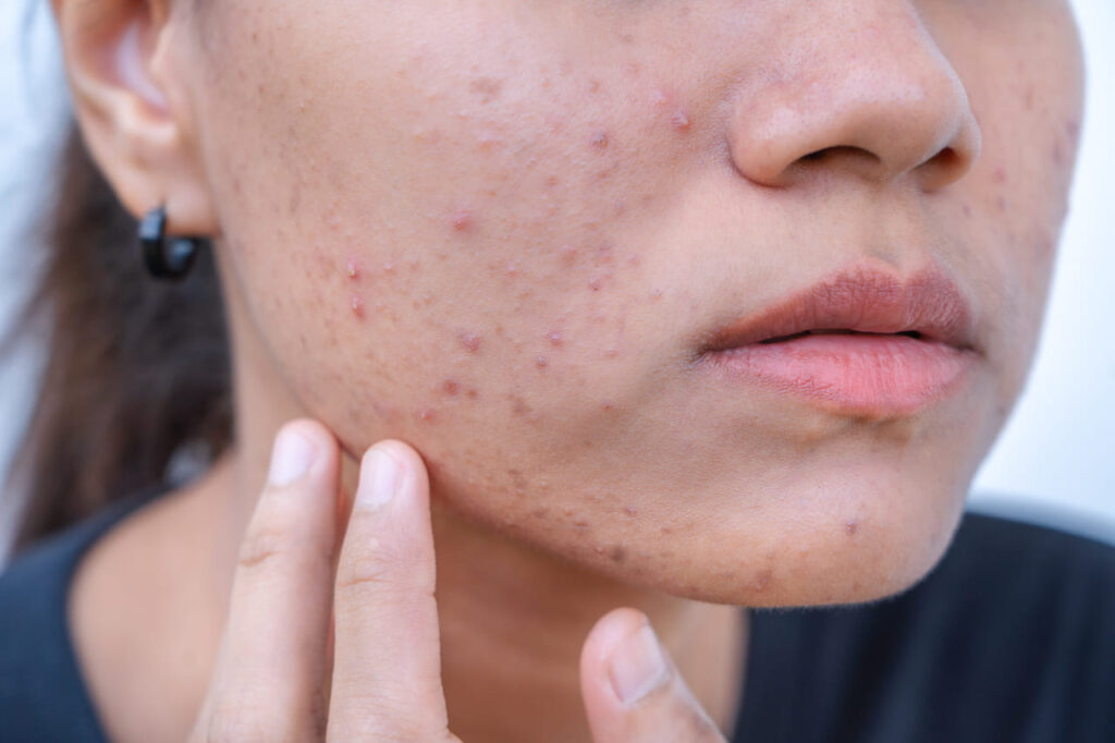 hormonale acne behandeling
