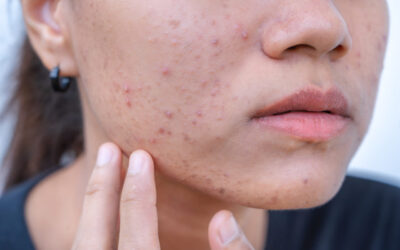 Hormonale acne
