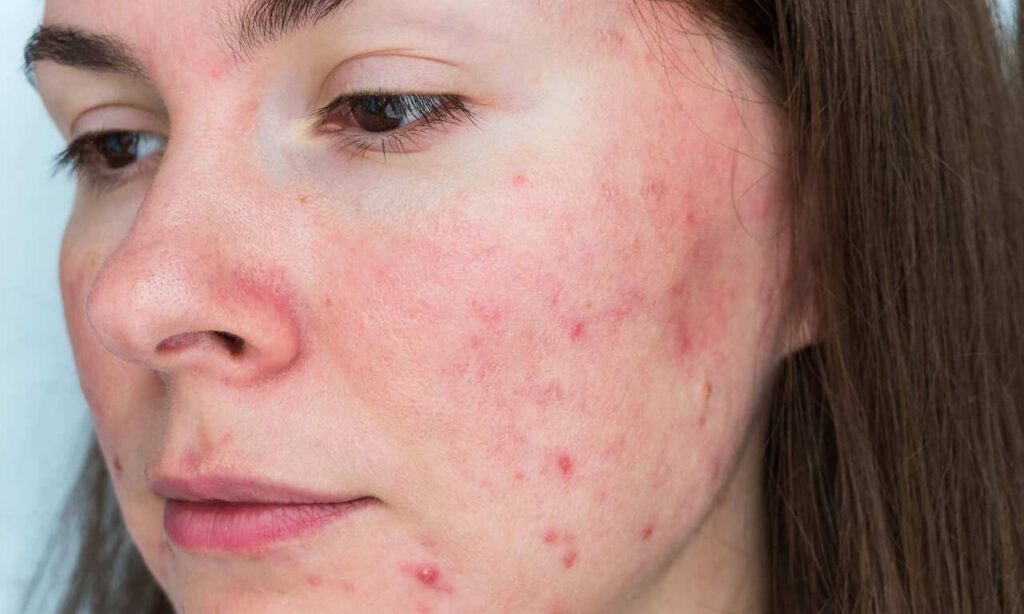 hormonale acne ortomolaculaire
