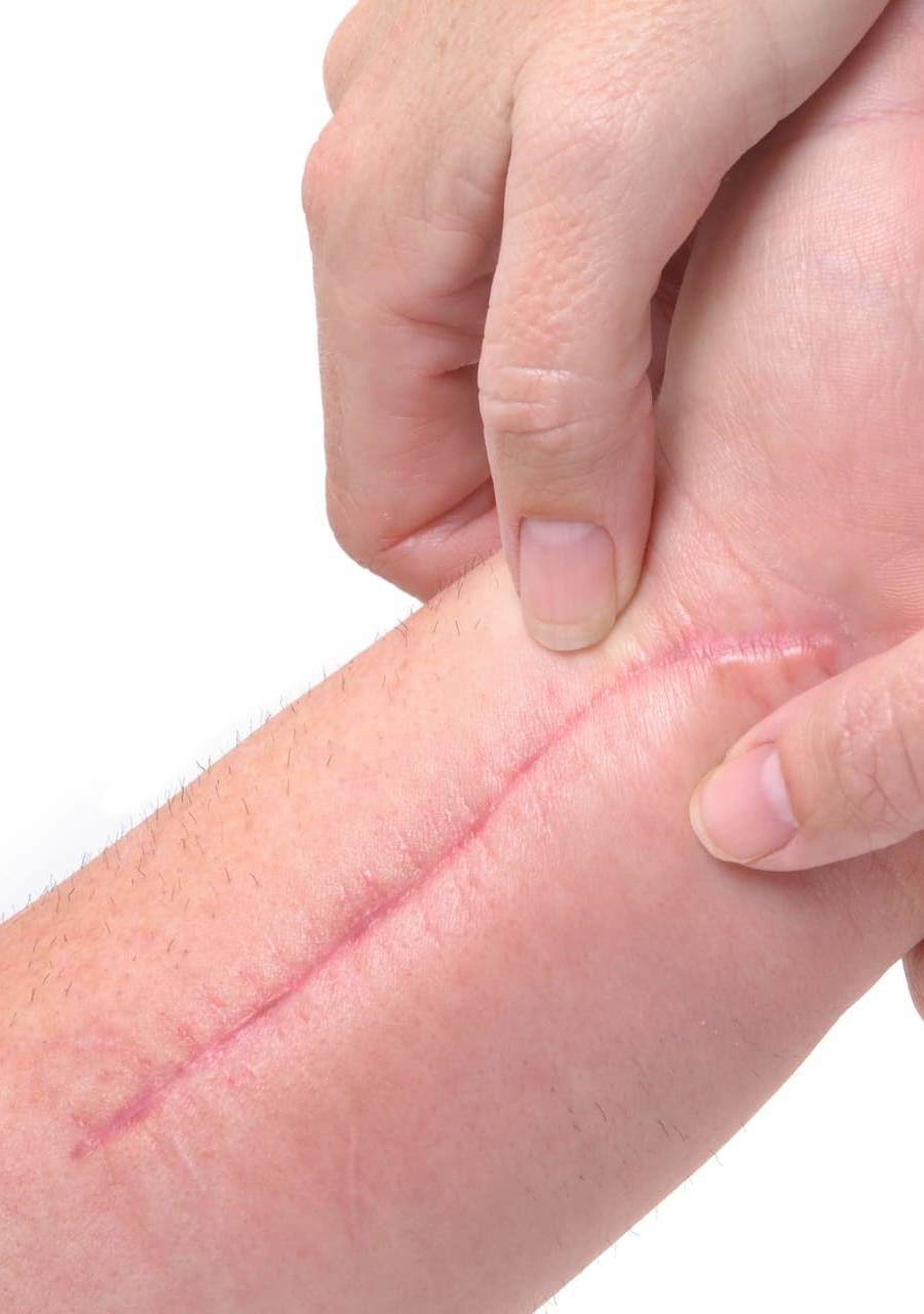 littekenbehandeling in hoofddorp littekenbehandeling in hoofddorp