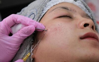 silicone littekens gel pleister